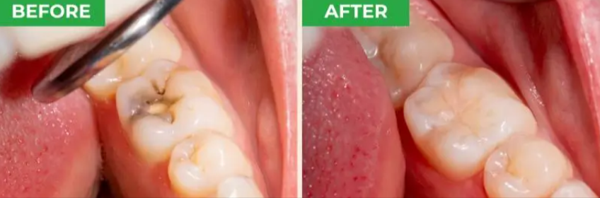 ProXental Benefits