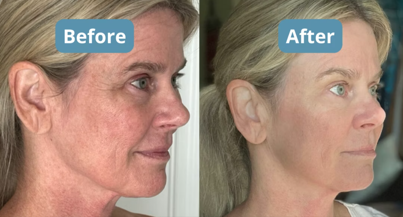 Total Night Cream before and after